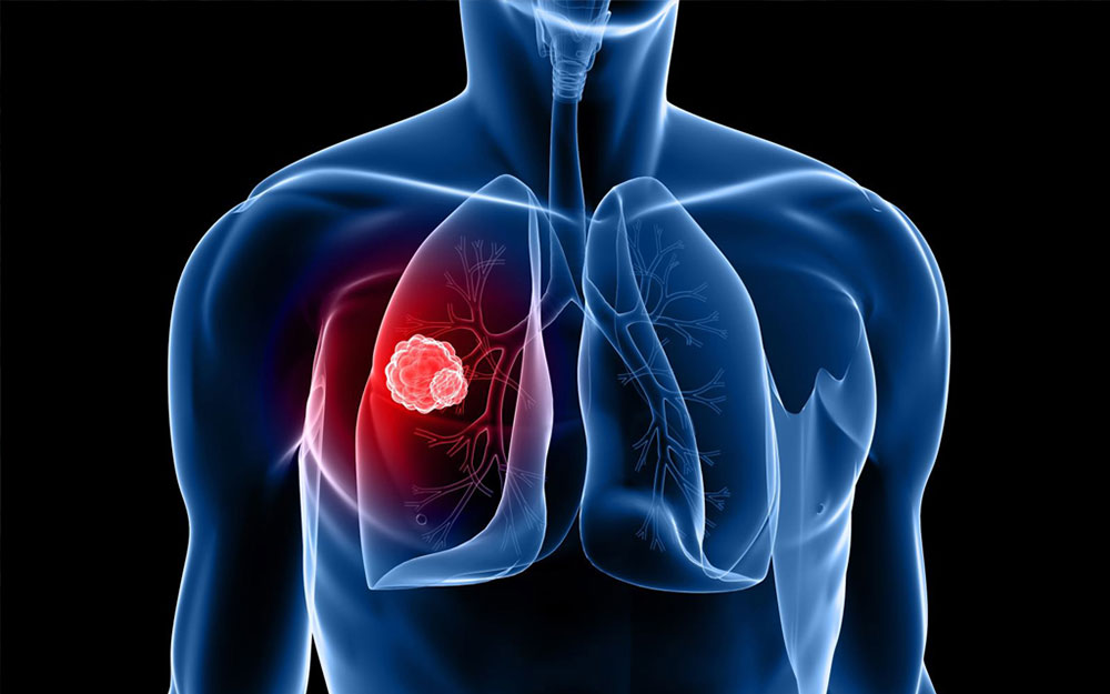 Faut'il surveiller de façon rapprochée après résection du cancer du poumon ?